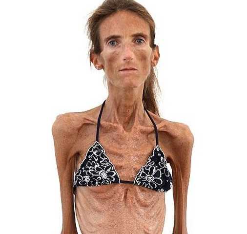 The 15-Year-Old Boy with the Body of an Old Man: 10 People Who Look Like Real-Life Aliens